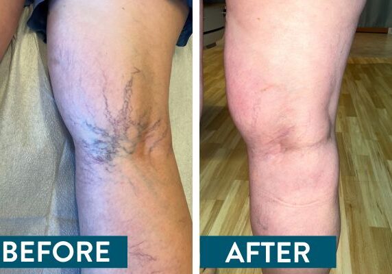 Side by side comparison photos of vein treatment patient's leg before and after